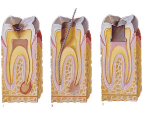 Endodonti