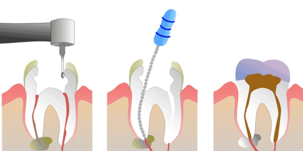 Endodonti